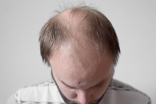 If you're bald, here's how to fix it
